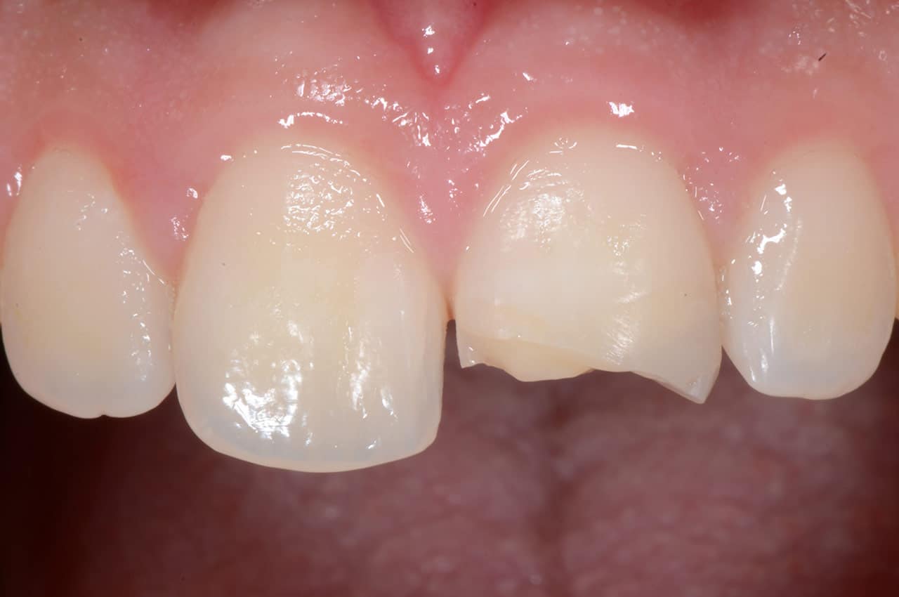 Prevenzione e la gestione clinica dei traumi dentali negli individui in età evolutiva